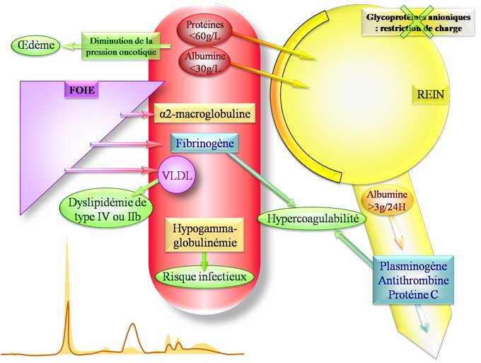 Syndrome néphrotique