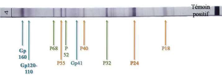 Western Blot : Test de confirmation VIH